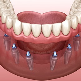 Illustration of implant dentures for lower arch