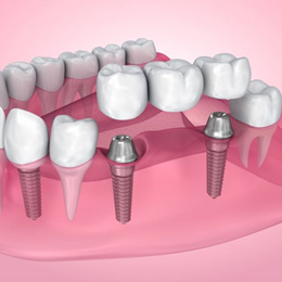 Exploded illustration of dental implants with bridge