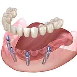 Illustration of removable dentures