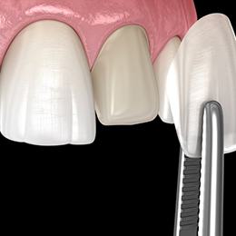A 3D illustration of the veneer process